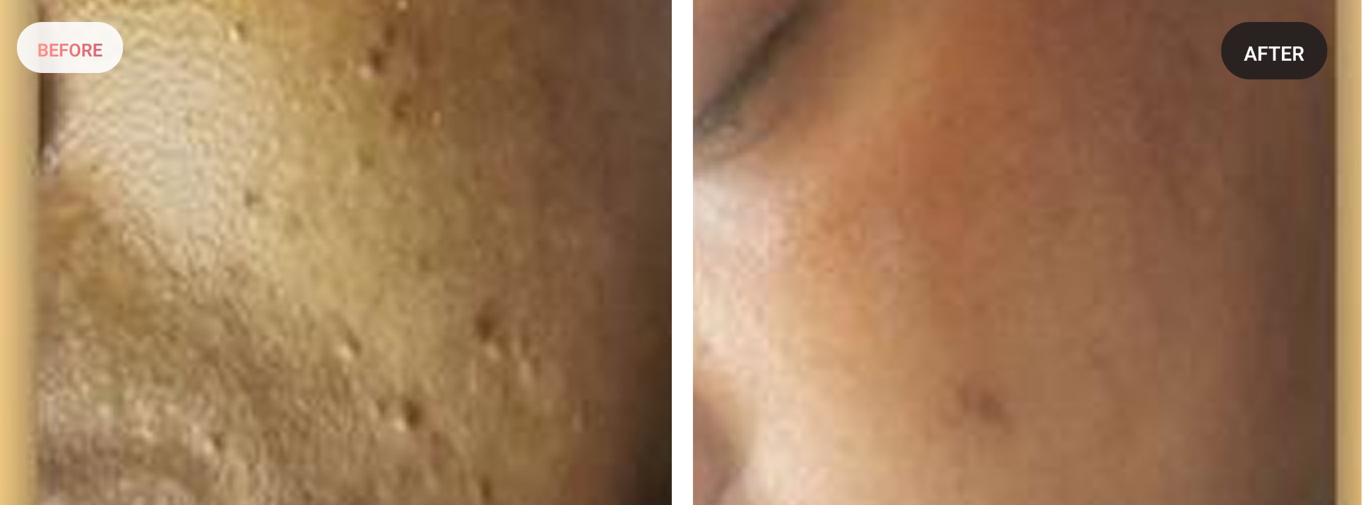 acne-scar-treatment-before-after-results-mississauga-3