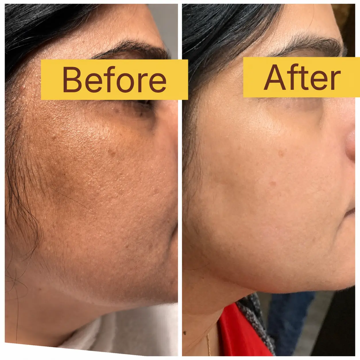 Before and after acne scar treatment in mississauga