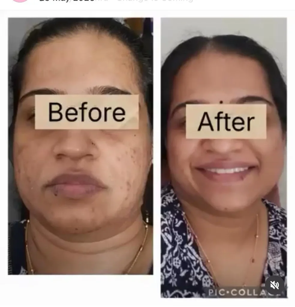 acne scar facial treatment mississauga